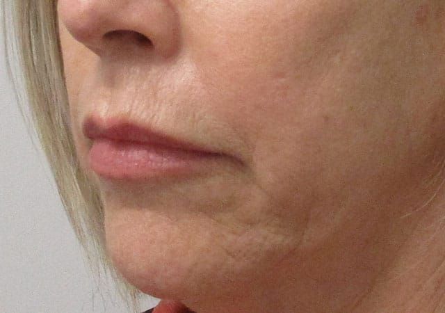 Chin Jawline Before & After