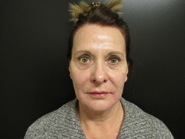 Chin Jawline Before & After