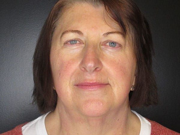 Chin Jawline Before & After