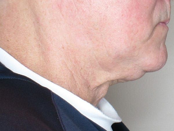 Chin Jawline Before & After