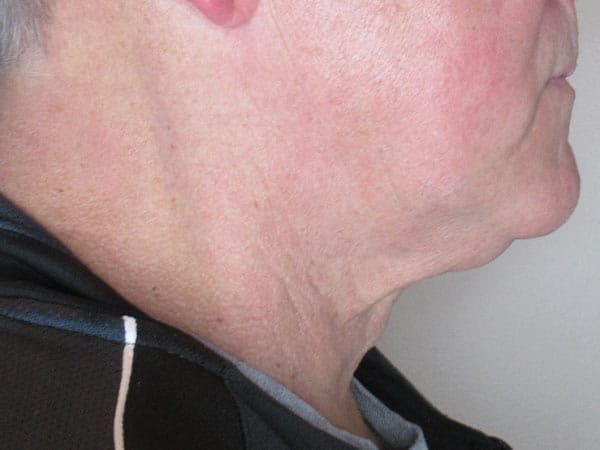 Chin Jawline Before & After