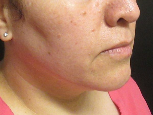 Chin Jawline Before & After