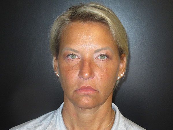 Chin Jawline Before & After