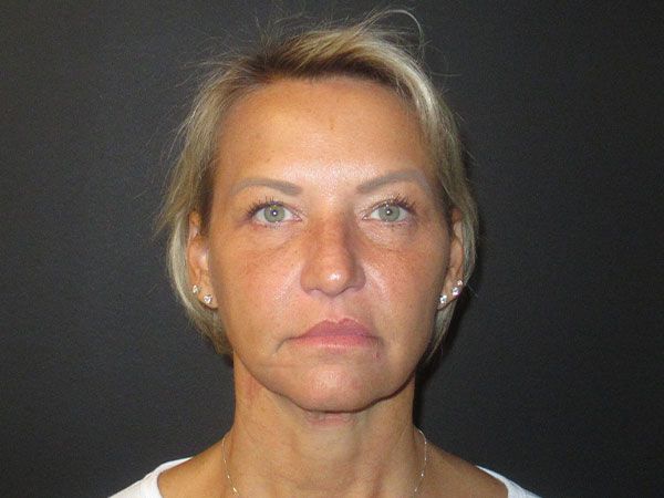 Chin Jawline Before & After