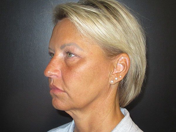 Chin Jawline Before & After