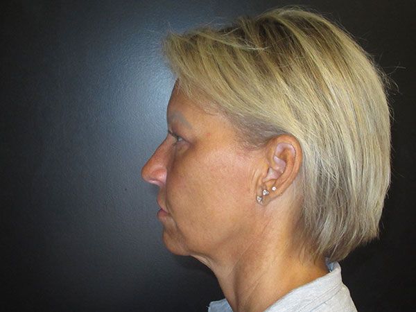 Chin Jawline Before & After