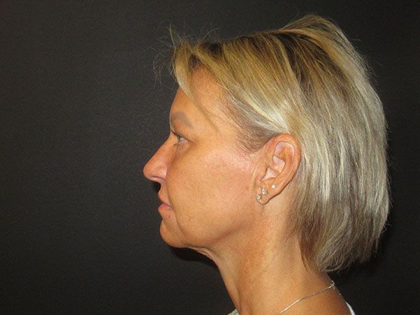 Chin Jawline Before & After