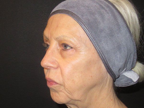 Chin Jawline Before & After