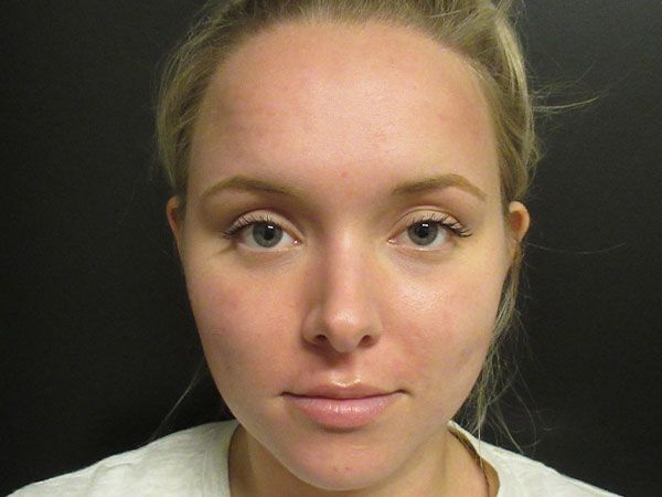 Chin Jawline Before & After