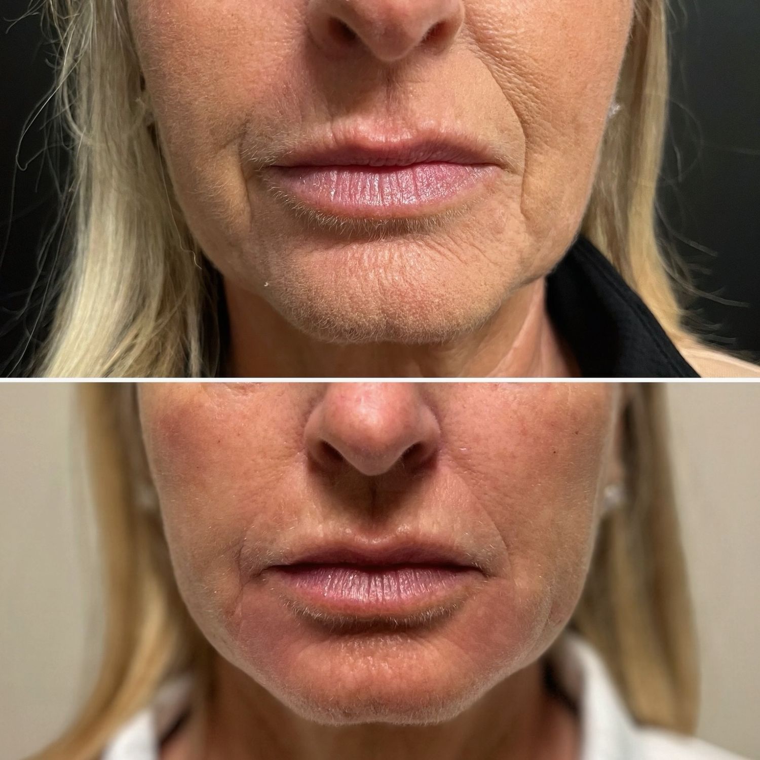 Chin & Jawline Enhancement Before & After
