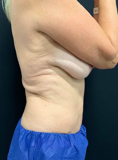 Coolsculpting Before & After