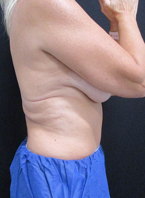Coolsculpting Before & After