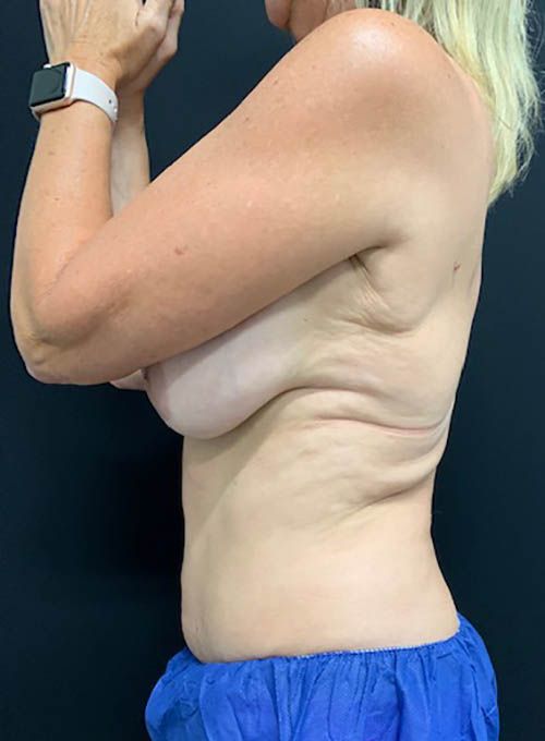 Coolsculpting Before & After