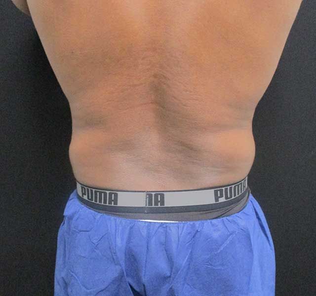 Coolsculpting Before & After