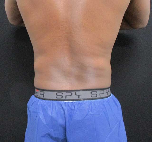 Coolsculpting Before & After