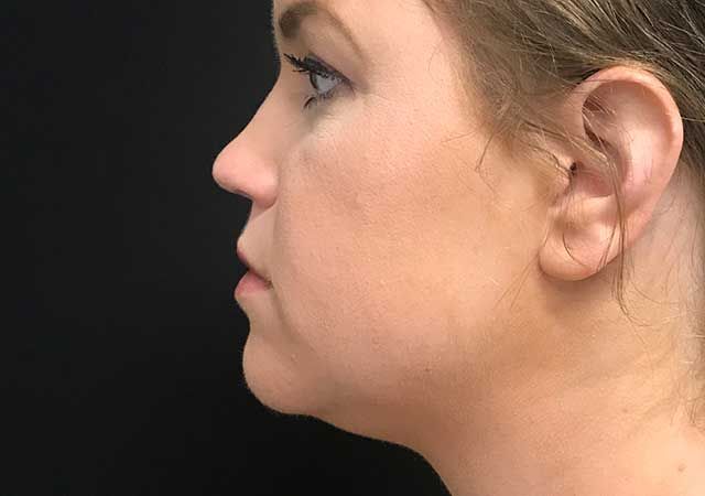 Coolsculpting Before & After