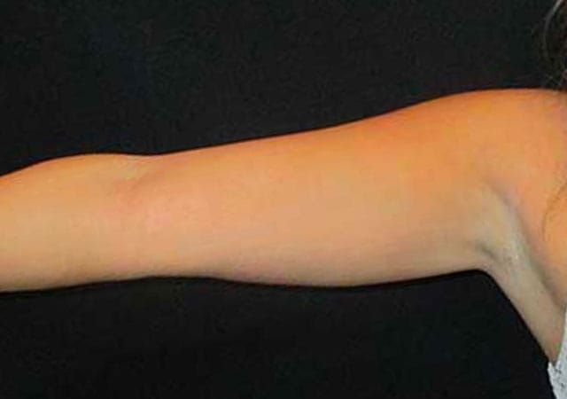 Coolsculpting Before & After