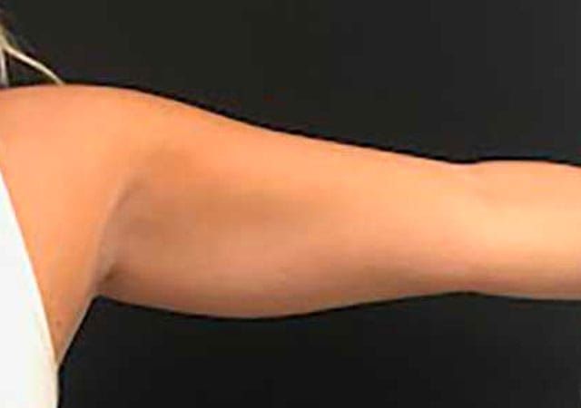 Coolsculpting Before & After