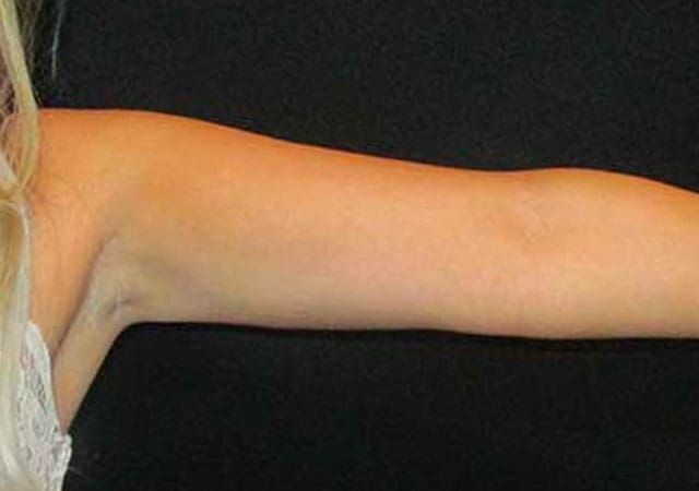 Coolsculpting Before & After