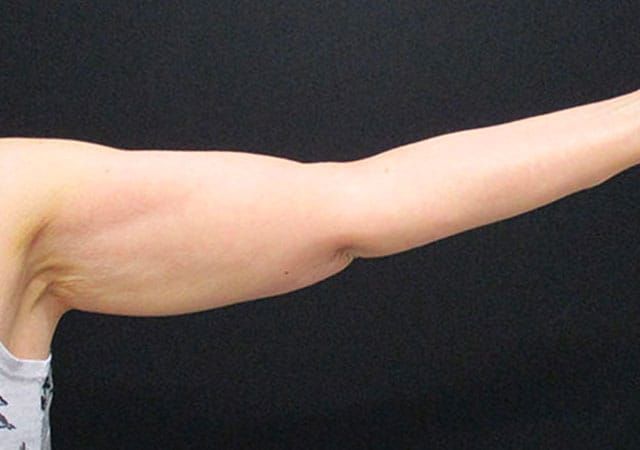 Coolsculpting Before & After