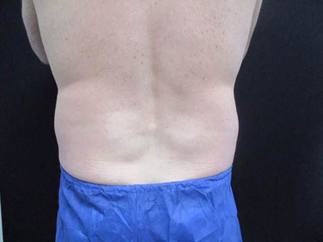 Coolsculpting Before & After