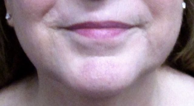 Coolsculpting Before & After