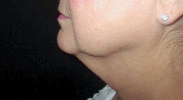 Coolsculpting Before & After