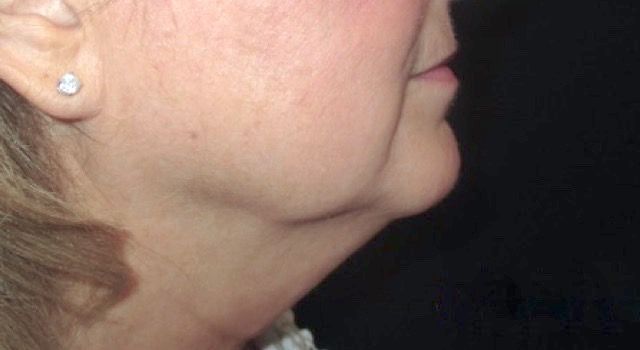 Coolsculpting Before & After