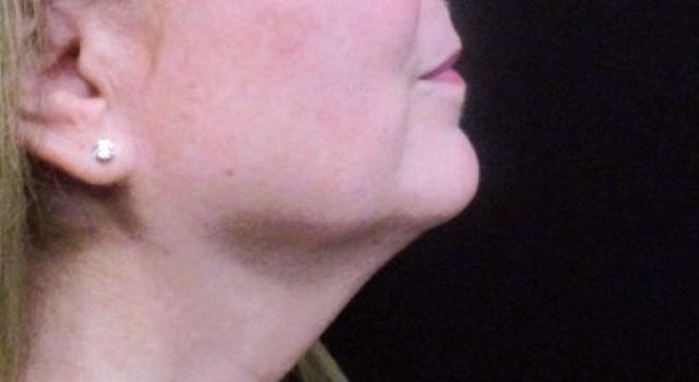 Coolsculpting Before & After