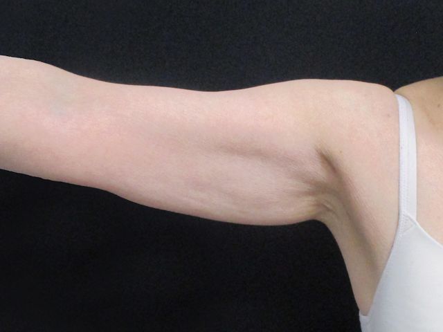 Coolsculpting Before & After