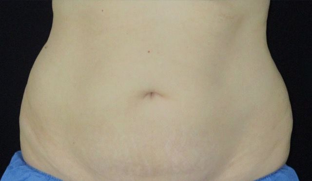 Coolsculpting Before & After