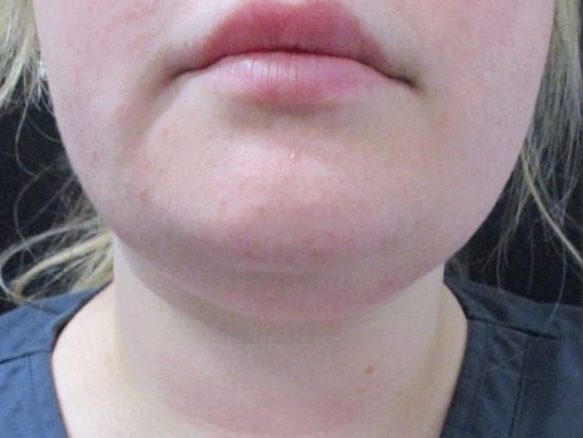 Coolsculpting Before & After