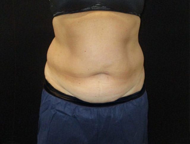 Coolsculpting Before & After