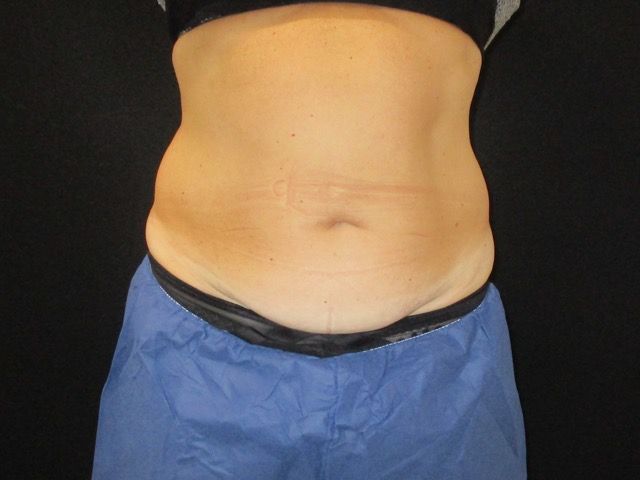 Coolsculpting Before & After
