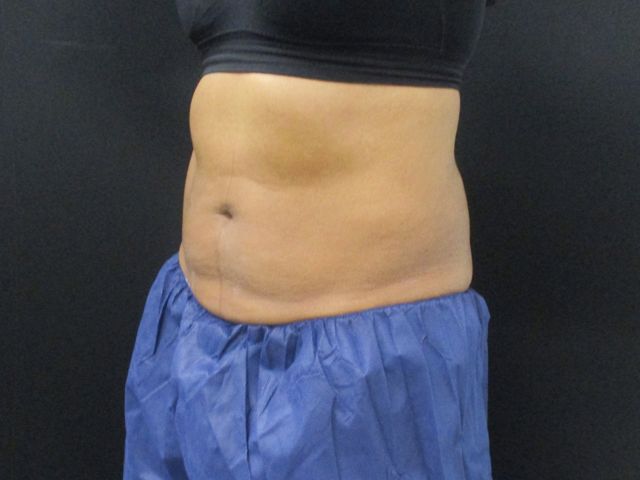 Coolsculpting Before & After