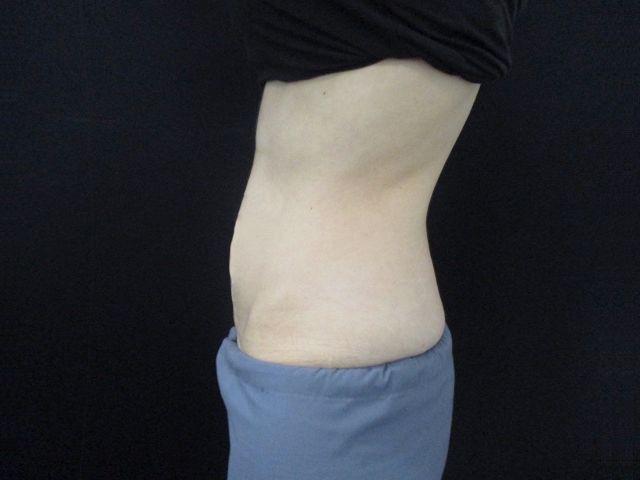 Coolsculpting Before & After