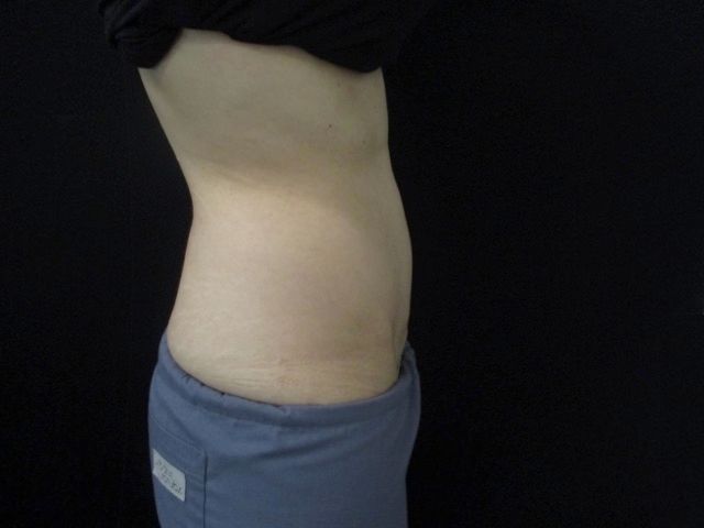 Coolsculpting Before & After