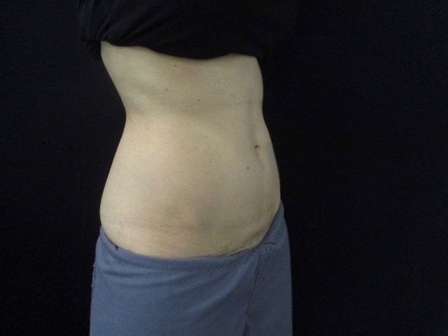 Coolsculpting Before & After