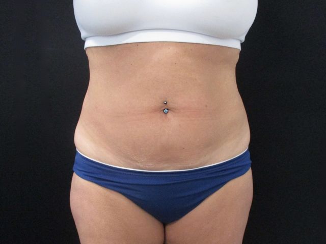 Coolsculpting Before & After