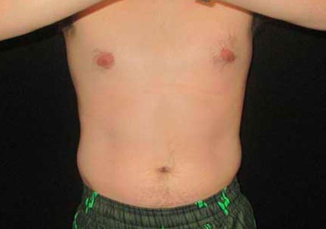 Coolsculpting Before & After