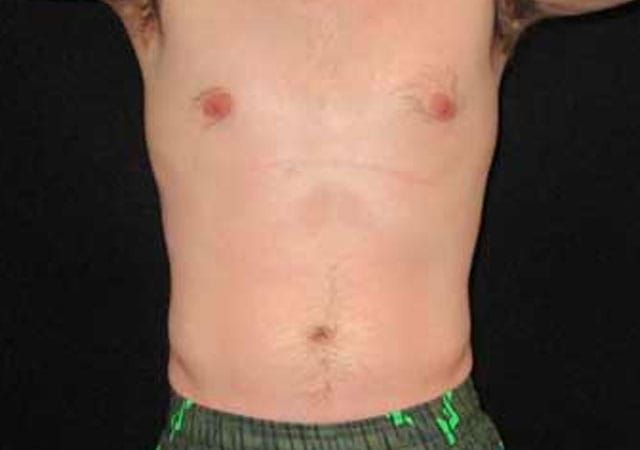 Coolsculpting Before & After