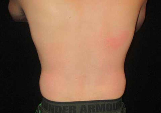 Coolsculpting Before & After