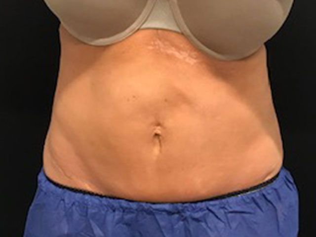 Coolsculpting Before & After