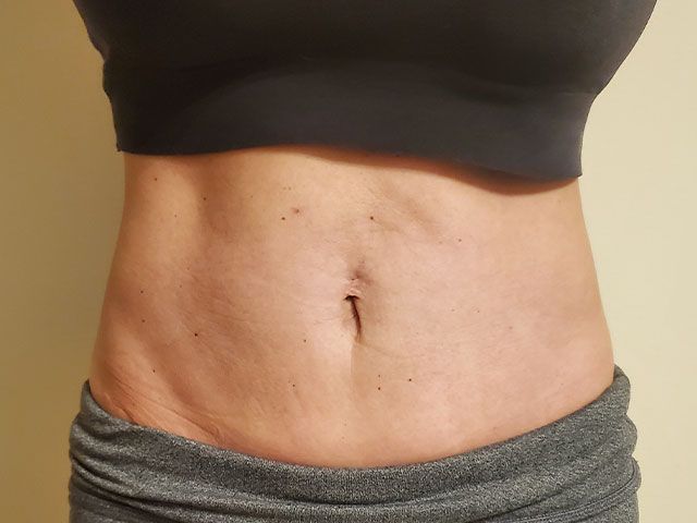 Coolsculpting Before & After