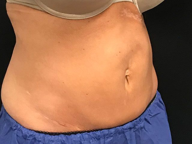 Coolsculpting Before & After