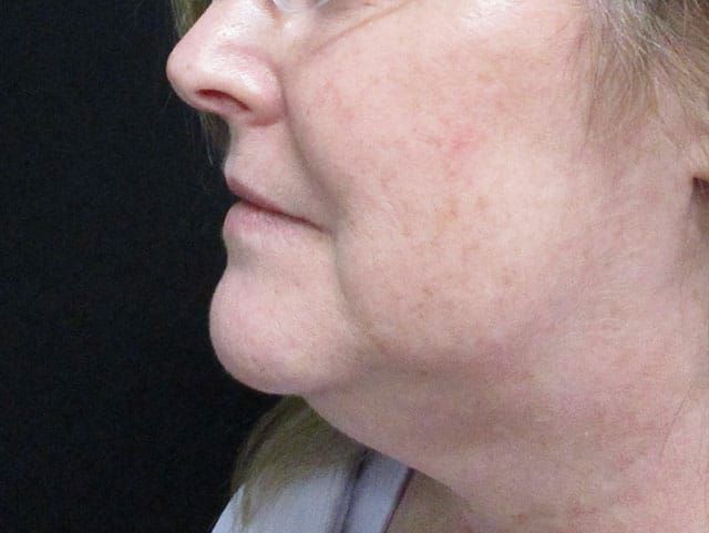 Coolsculpting Before & After