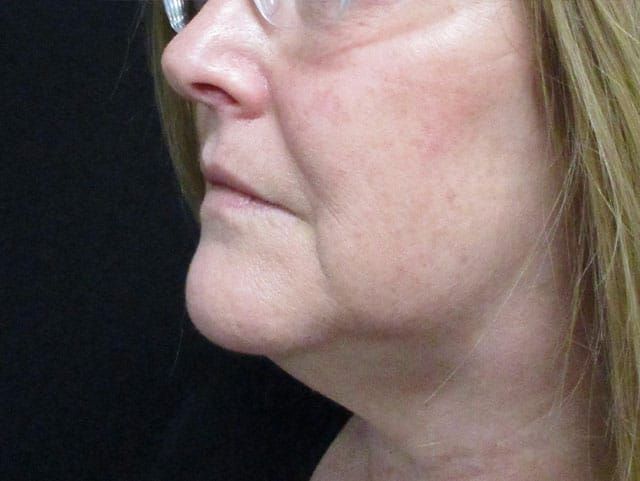 Coolsculpting Before & After