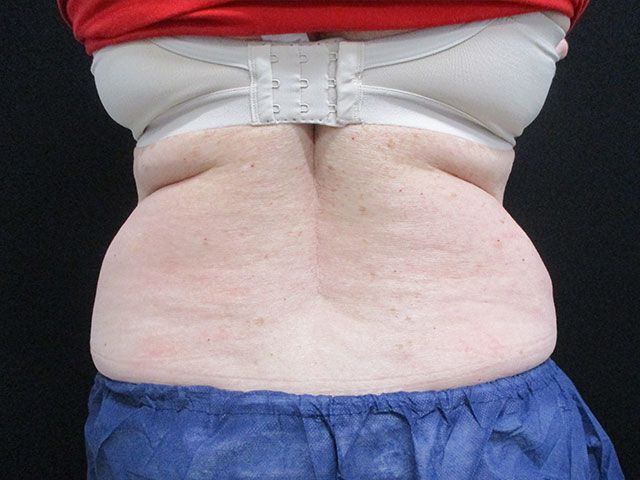 Coolsculpting Before & After