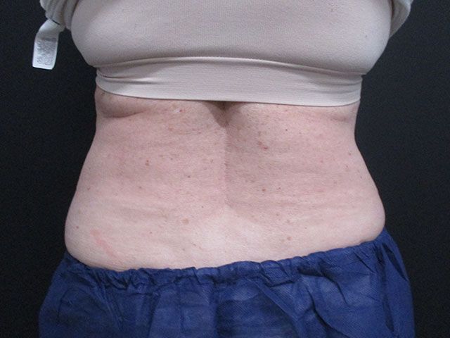 Coolsculpting Before & After