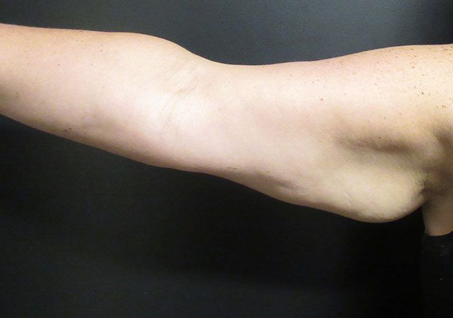 Coolsculpting Before & After